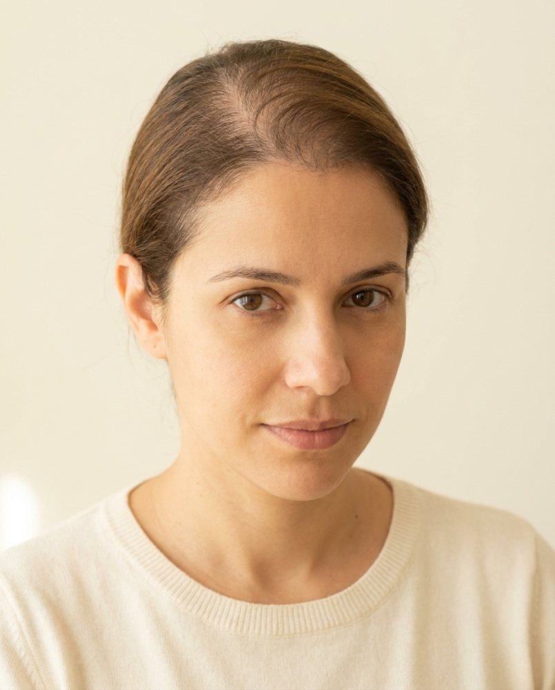 Mulher com rarefação no topo da cabeça, antes do topo capilar